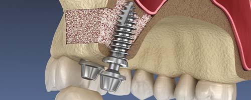 高難度のインプラント治療に対応
